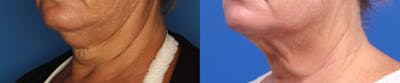 Kybella Before & After Gallery - Patient 905340 - Image 2