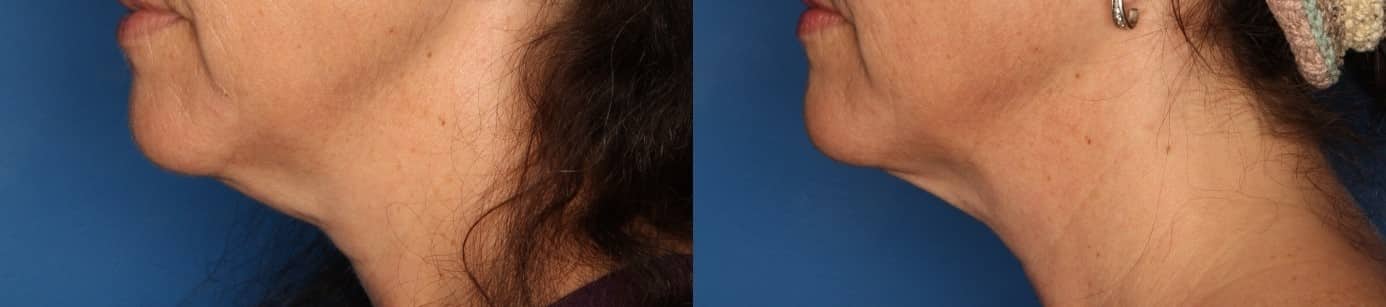 Kybella Before & After Gallery - Patient 415795 - Image 2