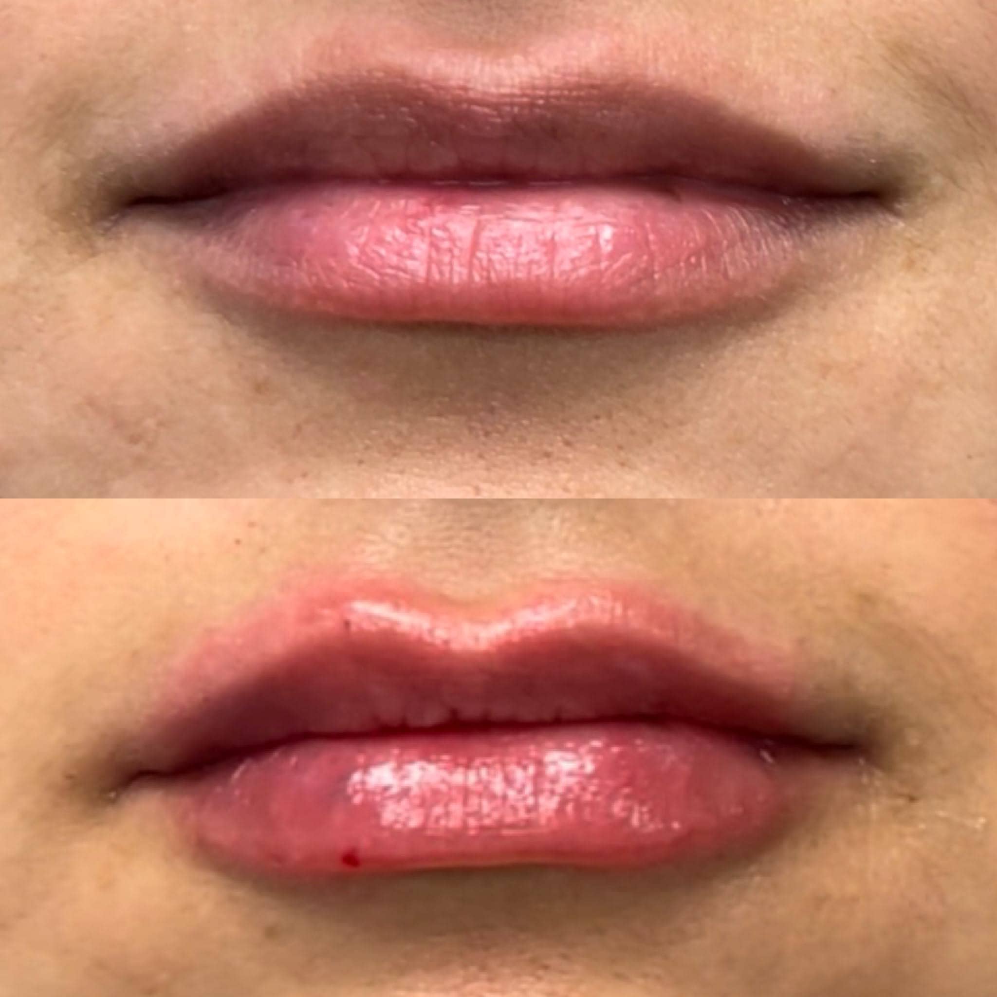 Lip Augmentation Before & After Gallery - Patient 188194 - Image 1