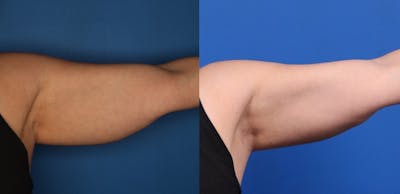 CoolSculpting Before & After Gallery - Patient 266954 - Image 4