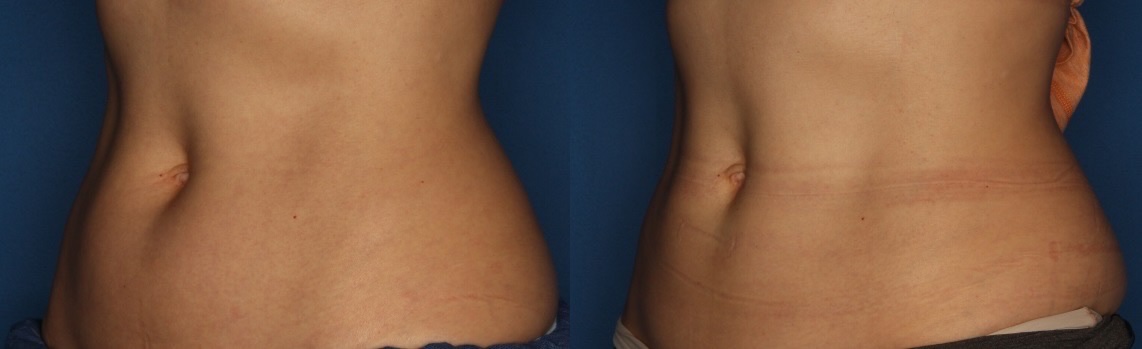 CoolSculpting Before & After Gallery - Patient 400738 - Image 2