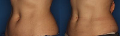 CoolSculpting Before & After Gallery - Patient 400738 - Image 2