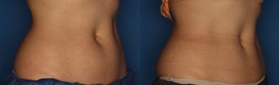 CoolSculpting Before & After Gallery - Patient 400738 - Image 4