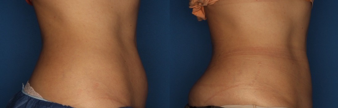 CoolSculpting Before & After Gallery - Patient 400738 - Image 5